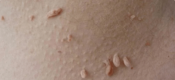 HPV transmission method