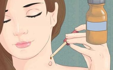 How to get rid of the popular remedies of the papillomas