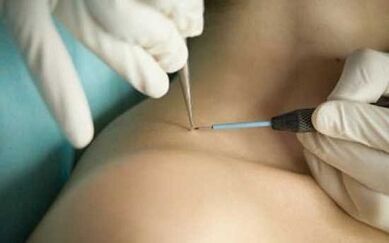 Methods of removing papillomas
