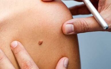 Methods of treatment of papillomas