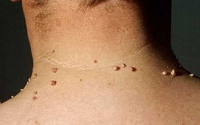 The reasons for the appearance of the papillomas