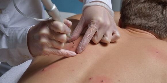 Removal of papillomas