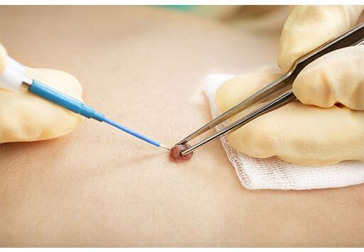 Removal of papillomas