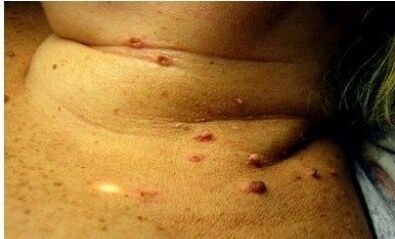 Photos of many papillomas in women