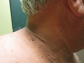 The reasons for the apparition of plural papillomas on the body