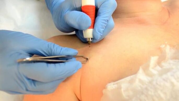 Electrocoagulation a method of removing papillomas