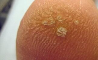 Why plantar warts appear