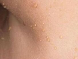 reasons for the appearance of papillomas on the body